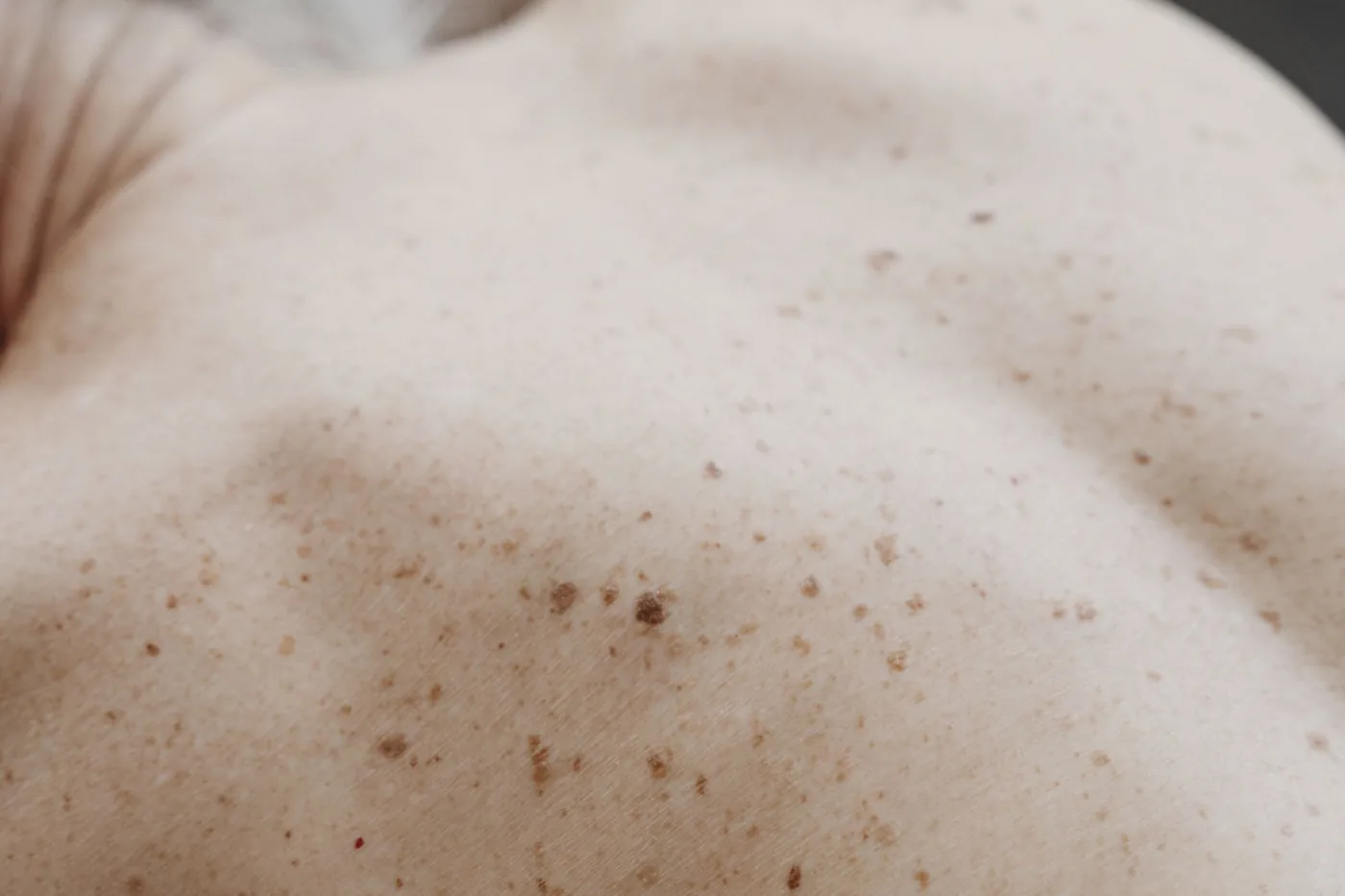 Ben kontrolünde ABCDE kuralı ve dermatoskopinin rolü