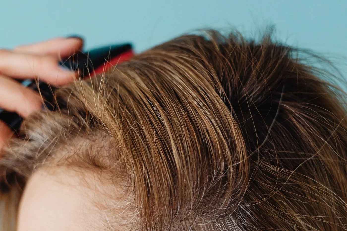 Kepek ve seboreik dermatit: neden tekrarlar, nasıl kontrol altına alınır?
