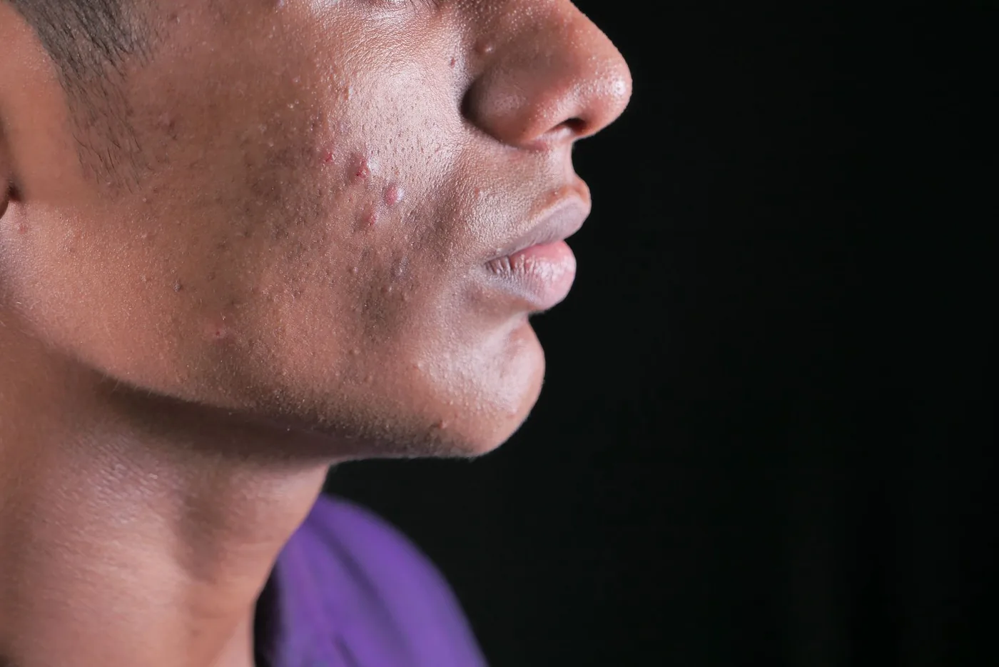 Sedef Hastalığı (Psoriasis)